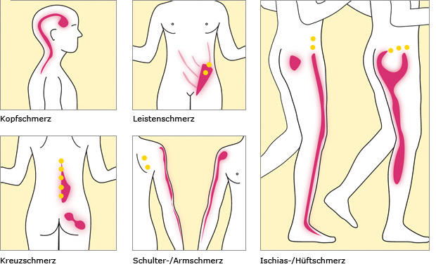 Schmerzsysmptome und Triggerpunkte